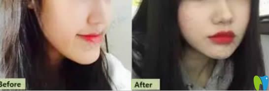 齙牙矯正案例效果及前后對比照