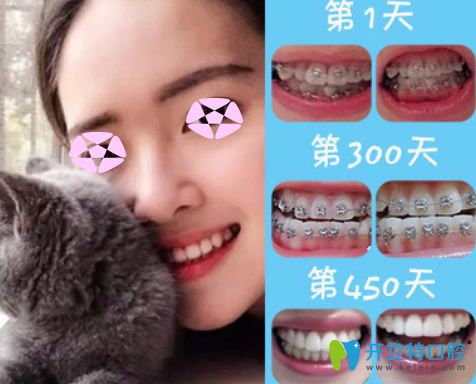 成人矯正牙齒效果好嗎？看上海伊爾意口腔正畸前后對(duì)比圖