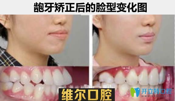 齙牙矯正后臉型對比案例