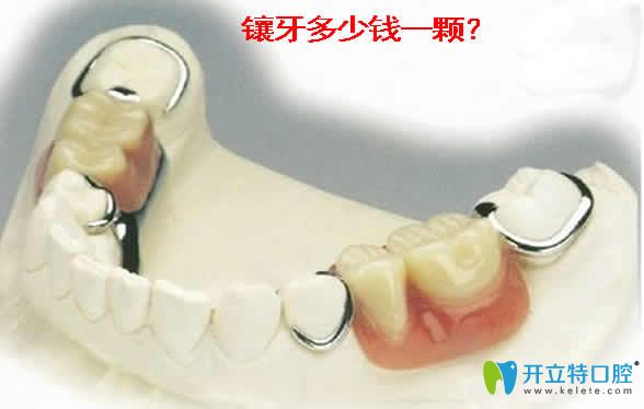 鑲牙多少錢(qián)一顆