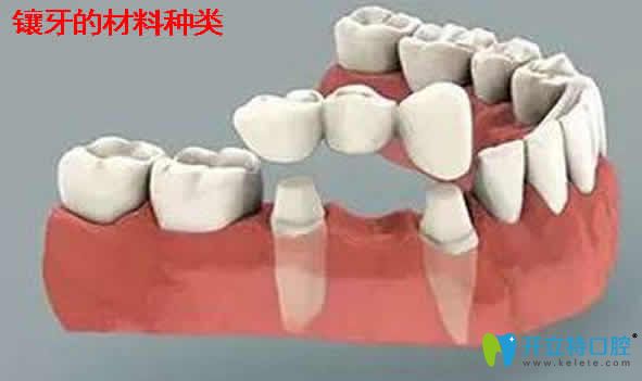 全面介紹鑲牙多少錢一顆及能用醫(yī)保嗎？