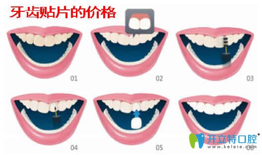 牙齒貼片的價(jià)格