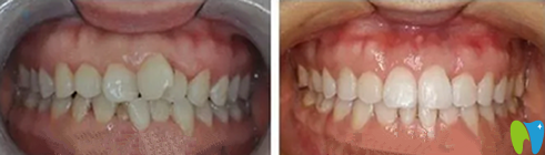 長(zhǎng)沙優(yōu)植口腔牙齒矯正效果圖