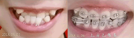 誠之康口腔周春醫(yī)生做牙齒矯正的三個月對比圖