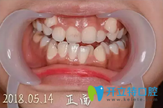 我在誠之康口腔矯正前照片