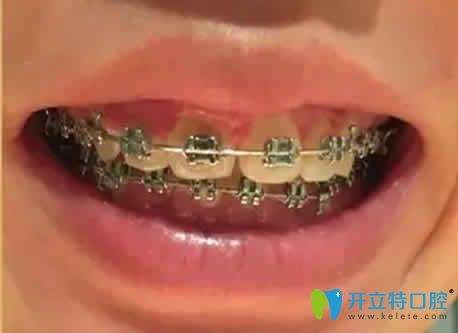 我在廣州偉聯(lián)口腔做自鎖托槽矯正第10個(gè)月照片