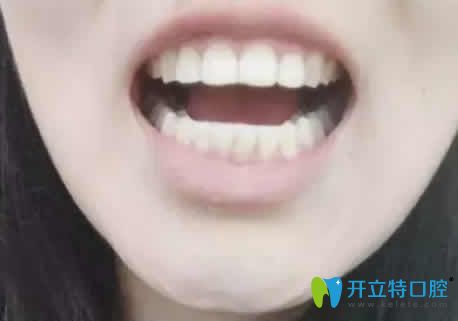 我在廣州偉聯(lián)口腔做正畸14個(gè)月效果