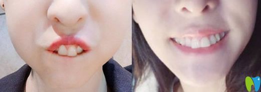 歌手張碧晨隱形矯正牙齒對比照
