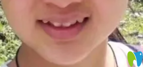 我在衡陽協(xié)合口腔矯正前照片