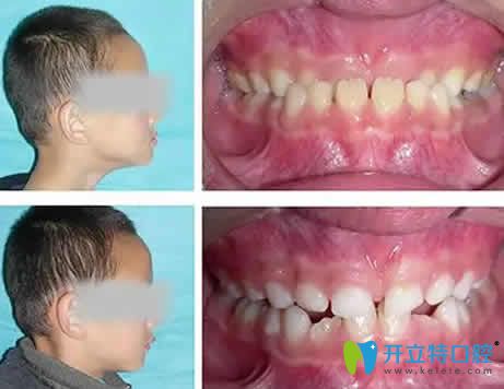 湛江南方口腔牙齒矯正前后對比圖