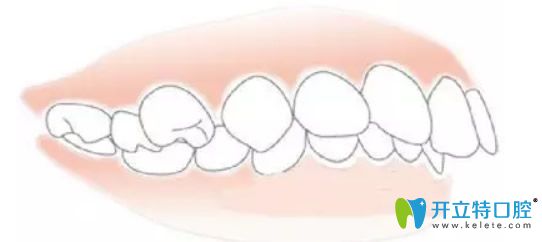 單純牙性齙牙圖片