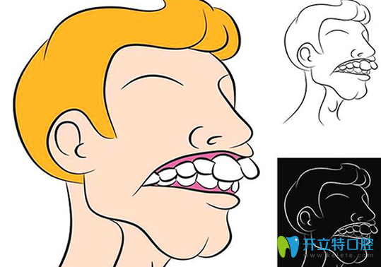 骨性齙牙通常伴有擁擠不齊，常與前牙深覆牙合