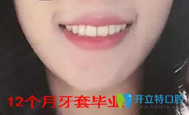 我在寧波拜博拜爾口腔做牙齒矯正1年取牙套后的照片 我在寧波拜博拜爾口腔做牙齒矯正1年取牙套后的照片