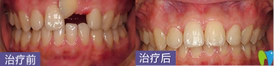 深圳烤瓷牙哪家好？鵬程口腔牙齒修復案例來嘍