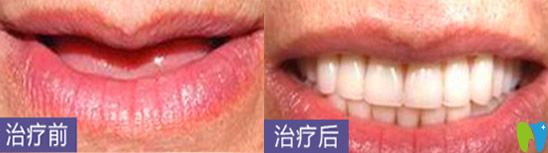 深圳哪家種植牙好？看深圳鵬程口腔種植牙案例