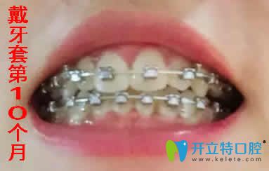 我在寧波拜博拜爾口腔做牙齒矯正10個(gè)月照片 我在寧波拜博拜爾口腔做牙齒矯正10個(gè)月照片