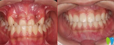 廈門亞歐齒科牙齒反合矯治效果圖 廈門亞歐齒科牙齒反合矯治效果圖