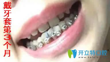 我在寧波拜博拜爾口腔做金屬自鎖托槽矯正第3個(gè)月照片 我在寧波拜博拜爾口腔做金屬自鎖托槽矯正第3個(gè)月照片