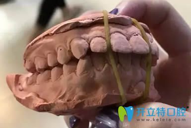 圍觀我花5萬多讓廈門賽德陽光洪慈憶做的齙牙矯正怎么樣？