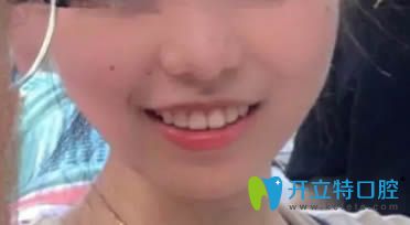 在<!--<i data=20240703-sp></i>-->口腔做完不拔牙矯正18個(gè)月后正畸效果