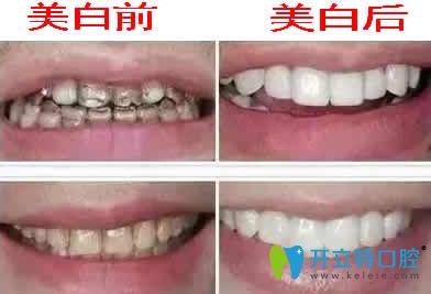 四環(huán)素牙美白前后對(duì)比圖