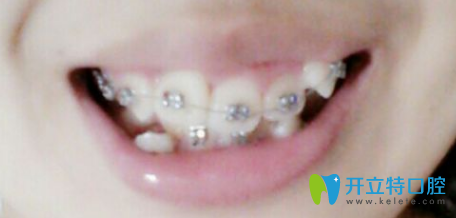 惠雯婷院長(zhǎng)正畸個(gè)月