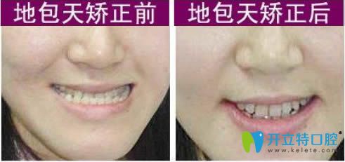 貴陽(yáng)華美口腔李森醫(yī)生地包天矯正案例及前后對(duì)比照
