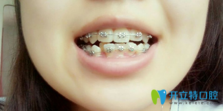 我在泉興口腔做牙齒矯正第四個(gè)月
