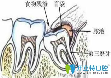 引起智齒冠周炎的原因是什么