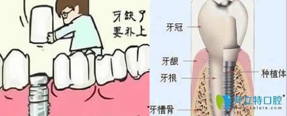 醫(yī)生告訴你為什么要做種植牙？種植牙哪里比假牙好？