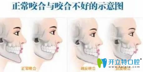半口或局部牙齒矯正可能會(huì)導(dǎo)致咬合不好示意圖