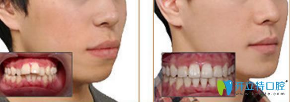 李智醫(yī)生齙牙矯正案例及臉型變化圖