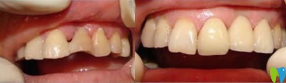 威海舒好口腔李歡牙體修復效果對比圖：
