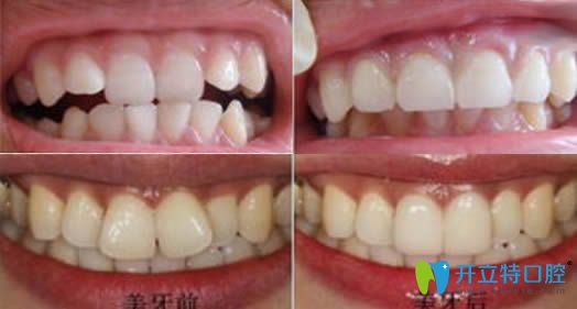 威海環(huán)翠區(qū)舒好口腔湯麗超牙齒正畸案例圖