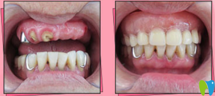 <!--<i data=20240703-sp></i>-->半口牙種植案例前后效果對比圖