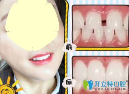 新橋口腔3D瓷貼面修復(fù)牙齒案例前后效果對