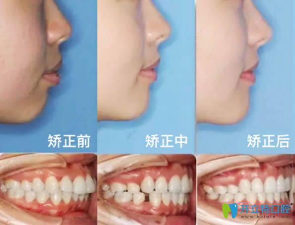 深圳拜爾口腔李銳景齙牙矯正及臉型變化圖 深圳拜爾口腔李銳景齙牙矯正及臉型變化圖