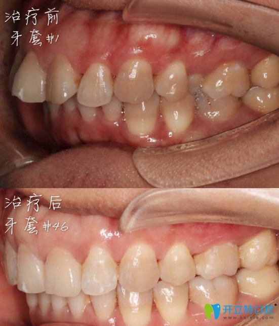 <!--<i data=20240703-sp></i>-->口腔正畸好不好？來看新橋口腔拔牙做隱形牙齒矯正案例