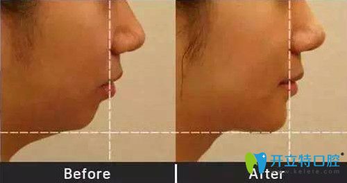 重慶齊美口腔矯正靠譜嗎？來看周映丞齙牙矯正真人案例前后效果對比圖