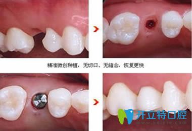 微創(chuàng)種植牙真人案例效果圖