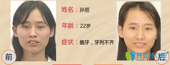 王亞東22歲女性齙牙矯正案例前后效果對比圖