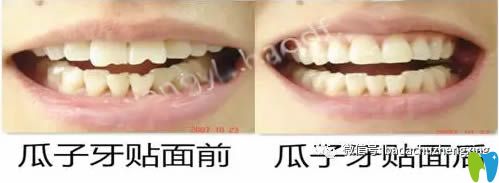 瓜子牙修復(fù)前后照片
