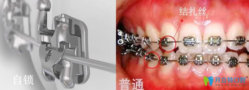 自鎖托槽矯正一萬(wàn)貴嗎？自鎖托槽比金屬托槽好在哪里？