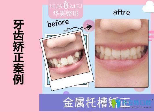 汕頭華美口腔王宏偉醫(yī)生虎牙矯正案例及對比效果