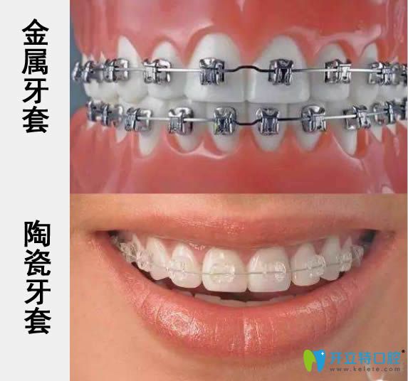 揭秘陶瓷和金屬牙套哪個(gè)好?通過(guò)價(jià)格及優(yōu)缺點(diǎn)來(lái)進(jìn)行大比拼