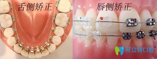 專業(yè)解答:唇側(cè)和舌側(cè)隱形矯正哪個(gè)好?并附上價(jià)格和效果圖