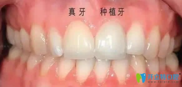 種植牙和真牙一樣嗎？不妨來(lái)看咀嚼功能及使用壽命的區(qū)別