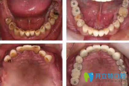 <!--<i data=20240703-sp></i>-->恒愿齒科劉奎恒愿速生牙效果對(duì)比圖 <!--<i data=20240703-sp></i>-->恒愿齒科劉奎恒愿速生牙效果對(duì)比圖