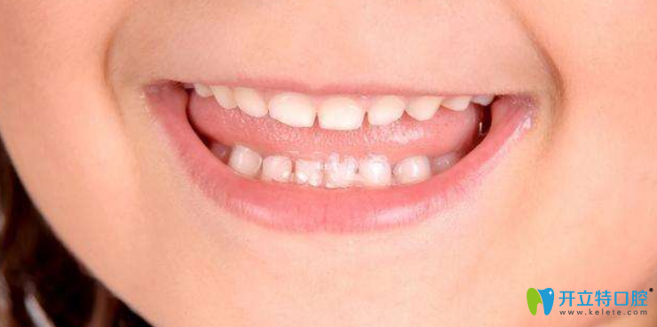 兒童換牙前矯正牙齒還是換牙后?附兒童牙齒矯正方法及價(jià)格