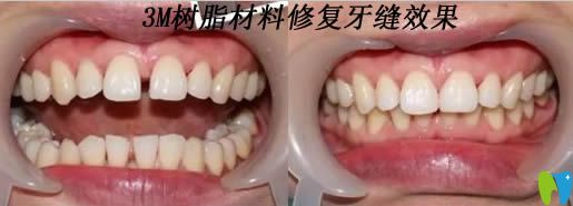 美國3M樹脂材料修復牙縫效果對比圖